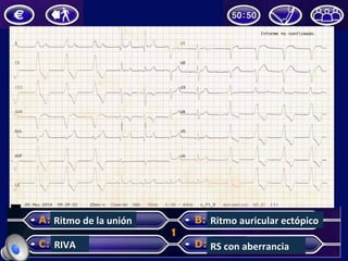 RS	con	aberrancia	RIVA	
Ritmo	auricular	ectópico	Ritmo	de	la	unión	
 