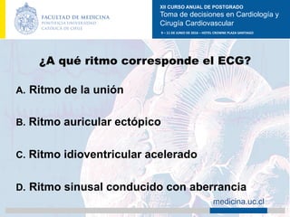 XII CURSO ANUAL DE POSTGRADO
Toma de decisiones en Cardiología y
Cirugía Cardiovascular
9	–	11	DE	JUNIO	DE	2016	–	HOTEL	CROWNE	PLAZA	SANTIAGO	
		 medicina.uc.cl
¿A qué ritmo corresponde el ECG?
A.  Ritmo de la unión
B.  Ritmo auricular ectópico
C.  Ritmo idioventricular acelerado
D.  Ritmo sinusal conducido con aberrancia	
 