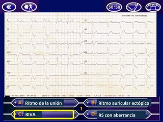 RS	con	aberrancia	RIVA	
Ritmo	auricular	ectópico	Ritmo	de	la	unión	
 