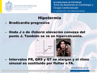XII CURSO ANUAL DE POSTGRADO
Toma de decisiones en Cardiología y
Cirugía Cardiovascular
9	–	11	DE	JUNIO	DE	2016	–	HOTEL	CROWNE	PLAZA	SANTIAGO	
		 medicina.uc.cl
Hipotermia
-  Bradicardia progresiva
-  Onda J o de Osborn: elevación convexa del
punto J. También se ve en hipercalcemia.
-  Intervalos PR, QRS y QT se alargan y el ritmo
sinusal es sustituido por flutter o FA.
	
 