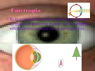 Es la condición óptica normal del ojo en la que una persona puede ver un objeto nítido sin necesidad de acomodación. 
