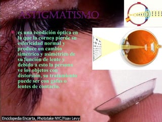 es una condición óptica en la que la cornea pierde su esfericidad normal y produce un cambio simétrico y asimétrico de su función de lente y debido a esto la persona ve los objetos con distorsión, su tratamiento puede ser con gafas o lentes de contacto. 