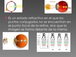 Es un estado refractivo en el que los puntos conjugados no se encuentran en el punto focal de la retina, sino que la imagen se forma delante de la misma. 