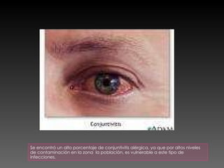Se encontró un alto porcentaje de conjuntivitis alérgica, ya que por altos niveles de contaminación en la zona  la población, es vulnerable a este tipo de infecciones. 