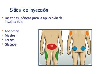 Sitios de Inyección 
• Las zonas idóneas para la aplicación de 
insulina son: 
• Abdomen 
• Muslos 
• Brazos 
• Glúteos 
 