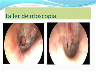 Taller de otoscopia: OM aguda
otitis media aguda inicia del oído izquierdo. Se
aprecia la membrana timpánica con congestió...