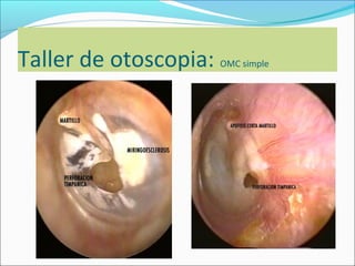 Taller de otoscopia
      La retracción (fig. 2) se debe a una
       presión negativa en oído medio.
      En esta posi...