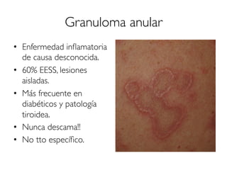 Granuloma anular
•  Enfermedad inﬂamatoria
de causa desconocida.
•  60% EESS, lesiones
aisladas.
•  Más frecuente en
diabéticos y patología
tiroidea.
•  Nunca descama!!
•  No tto especíﬁco.
 