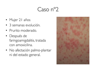 Caso nº2
•  Mujer 21 años
•  3 semanas evolución.
•  Prurito moderado.
•  Después de
faringoamigdalitis, tratada
con amoxicilina.
•  No afectación palmo-plantar
ni del estado general.
 