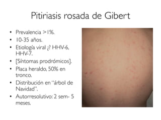 Pitiriasis rosada de Gibert
•  Prevalencia >1%.
•  10-35 años.
•  Etiología viral ¿? HHV-6,
HHV-7.
•  [Síntomas prodrómicos].
•  Placa heraldo, 50% en
tronco.
•  Distribución en “árbol de
Navidad”.
•  Autorresolutivo: 2 sem- 5
meses.
 
