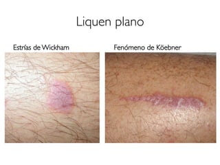 Liquen plano
Estrías de Wickham Fenómeno de Köebner
 