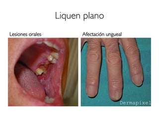 Liquen plano
Lesiones orales Afectación ungueal
 