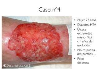 Caso nº4
•  Mujer 77 años
•  Diabetes, HTA
•  Úlcera
extremidad
inferior 9x7
cm años de
evolución.
•  No respuesta
atb, parches…
•  Poco
dolorosa.
 