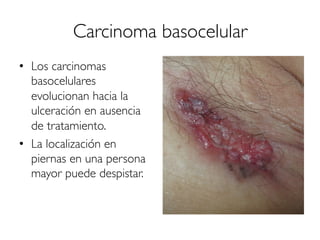 Carcinoma basocelular
•  Los carcinomas
basocelulares
evolucionan hacia la
ulceración en ausencia
de tratamiento.
•  La localización en
piernas en una persona
mayor puede despistar.
 