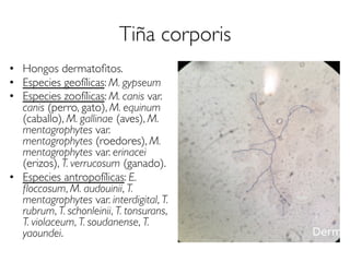 Tiña corporis
•  Hongos dermatoﬁtos.
•  Especies geofílicas: M. gypseum
•  Especies zoofílicas: M. canis var.
canis (perro, gato), M. equinum
(caballo), M. gallinae (aves), M.
mentagrophytes var.
mentagrophytes (roedores), M.
mentagrophytes var. erinacei
(erizos), T. verrucosum (ganado).
•  Especies antropofílicas: E.
ﬂoccosum, M. audouinii, T.
mentagrophytes var. interdigital, T.
rubrum, T. schonleinii, T. tonsurans,
T. violaceum, T. soudanense, T.
yaoundei.
 