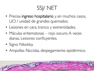 SSJ/ NET
•  Precisa ingreso hospitalario y, en muchos casos,
UCI / unidad de grandes quemados.
•  Lesiones en cara, tronco y extremidades.
•  Máculas eritematosas – rojo oscuro.A veces
dianas. Lesiones conﬂuyentes.
•  Signo Nikolsky.
•  Ampollas ﬂáccidas, despegamiento epidérmico.
 