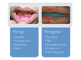 Pénﬁgo
• Jóvenes
• Mucosa oral
• Erosiones
• Raro
Penﬁgoide
• Ancianos
• Piel
• Ampollas tensas
• Prurito ++
• Más frecuente
 