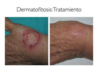 Dermatoﬁtosis:Tratamiento
 