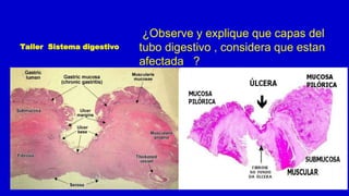 ¿Observe y explique que capas del
tubo digestivo , considera que estan
afectada ?
Taller Sistema digestivo
 
