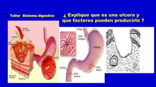 Taller Sistema digestivo ¿ Explique que es una ulcera y
que factores pueden producirla ?
 