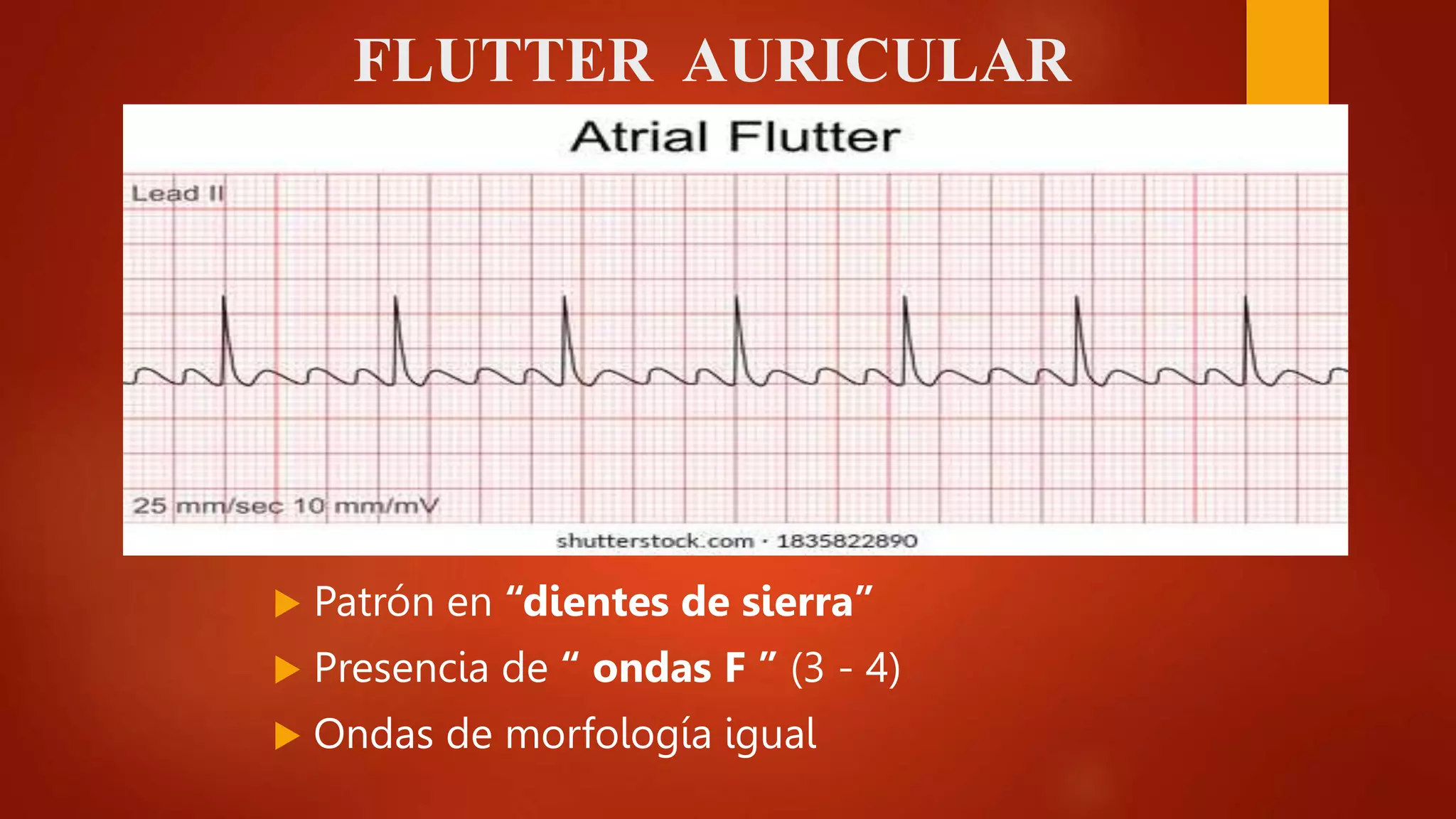 Is The Rto R Regular In A Flutter TALLER ECG parte 2.pptx