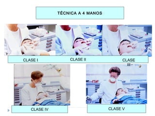 TÉCNICA A 4 MANOS

CLASE I

CLASE IV

CLASE II

CLASE
III

CLASE V

 