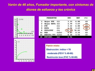 Varón de 46 años, Fumador importante, con síntomas de
disnea de esfuerzo y tos crónica

Patrón mixto:
Obstrucción: indice < 70
moderada (FEV1 % 40-60)
Restricción leve (FVC % 60-80)

 