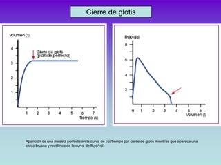 Cierre de glotis




Aparición de una meseta perfecta en la curva de Vol/tiempo por cierre de glotis mientras que aparece ...