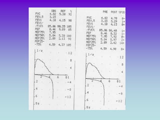 Espirometria con curvas normales.
Valores alterados: PATRON ESPIROMETRICO obstructivo
PBD Positiva (>12%)
 