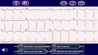 Electrodos	mal	posicionados
Ritmo	auricular	bajo
Situs	inversus
Bloqueo	de	rama	alternante
 
