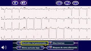 Electrodos	mal	posicionados
Ritmo	auricular	bajo
Situs	inversus
Bloqueo	de	rama	alternante
 