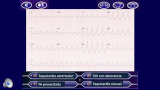 Taquicardia	ventricular
FA	preexcitada
TSV	con	aberrancia
Taquicardia	sinusal
 