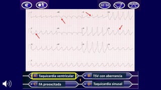 Taquicardia	ventricular
FA	preexcitada
TSV	con	aberrancia
Taquicardia	sinusal
 