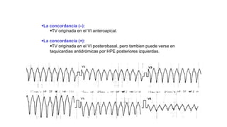 XII CURSO ANUAL DE POSTGRADO
Toma de decisiones e Cardiología y
Cirugía Cardiovascular
§La concordancia (–):
§TV originada en el VI anteroapical.
§La concordancia (+):
§TV originada en el VI posterobasal, pero tambien puede verse en
taquicardias antidrómicas por HPE posteriores izquierdas.
 