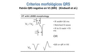 Criterios morfológicos QRS
Patrón	QRS	negativo	en	V1	(BRI)			(Kindwall et	al.)
 