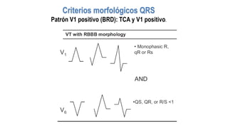 Criterios morfológicos QRS
Patrón V1 positivo (BRD): TCA y V1 positivo.
 