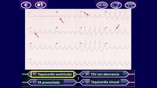 Taquicardia	ventricular
FA	preexcitada
TSV	con	aberrancia
Taquicardia	sinusal
 