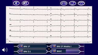 BAV	1º
BAV	2:1
BAV	2º	Mobitz	I
BAVC
 