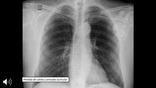 Pérdida	de	salida	y	sensado auricular
 