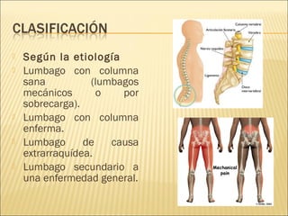 






Según la etiología
Lumbago con columna
sana
(lumbagos
mecánicos
o
por
sobrecarga).
Lumbago con columna
enferma.
Lumbago
de
causa
extrarraquídea.
Lumbago secundario a
una enfermedad general.

 