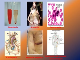 Hematuria        Anorexia            Leucopenia




                                  Supresión del sistema
Cardiopatía   Necrosis hepática
                                      inmunológico
 