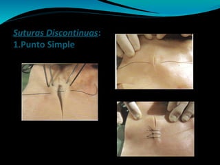 Suturas Discontinuas:
1.Punto Simple
 