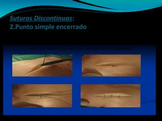 Suturas Discontinuas:
2.Punto simple encerrado
 