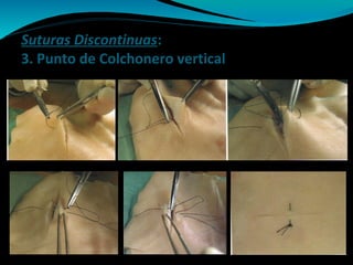 Suturas Discontinuas:
3. Punto de Colchonero vertical
 