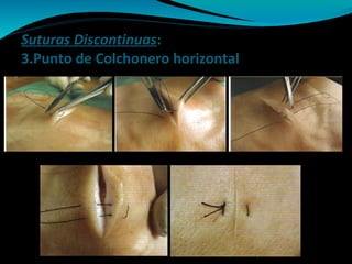 Suturas Discontinuas:
3.Punto de Colchonero horizontal
 