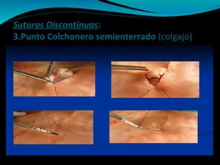 Suturas Discontinuas:
3.Punto Colchonero semienterrado (colgajo)
 