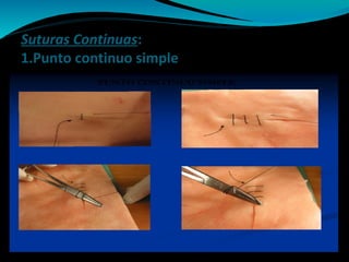 Suturas Continuas:
1.Punto continuo simple
 