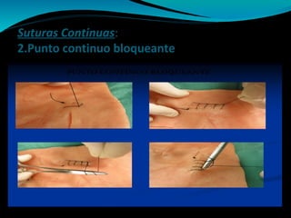 Suturas Continuas:
2.Punto continuo bloqueante
 