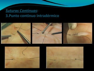 Suturas Continuas:
3.Punto continuo intradérmico
 