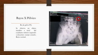 Rayos X Pélvico
Rx de pelvis PA:
Se observa un objeto
metálico a nivel del
cuadrante inferior izquierdo
a descartar: cuerpo extraño.
Resto normal.
 